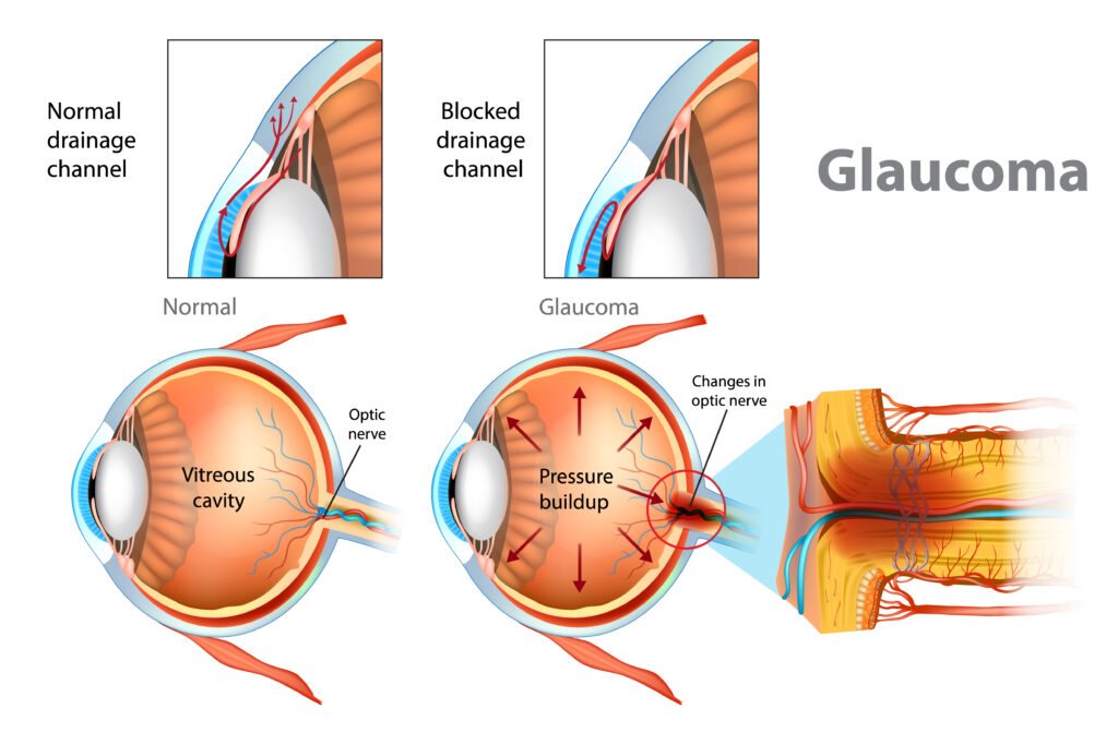 glaukoma